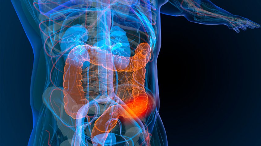 El càncer de còlon i recte té una taxa de curació superior al 90% si es detecta a temps