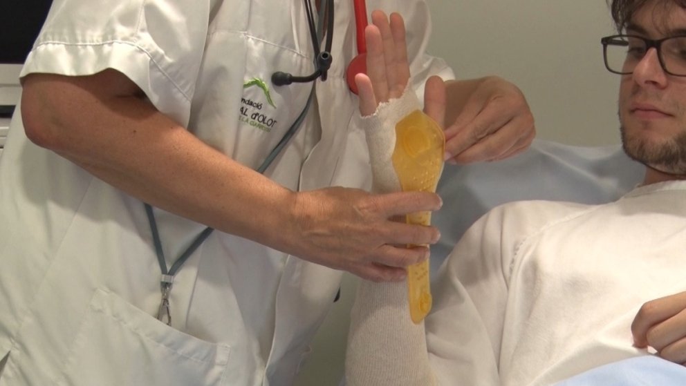 L’Hospital d’Olot i Comarcal de la Garrotxa comença a provar fèrules 3D per a fractures de radi distal